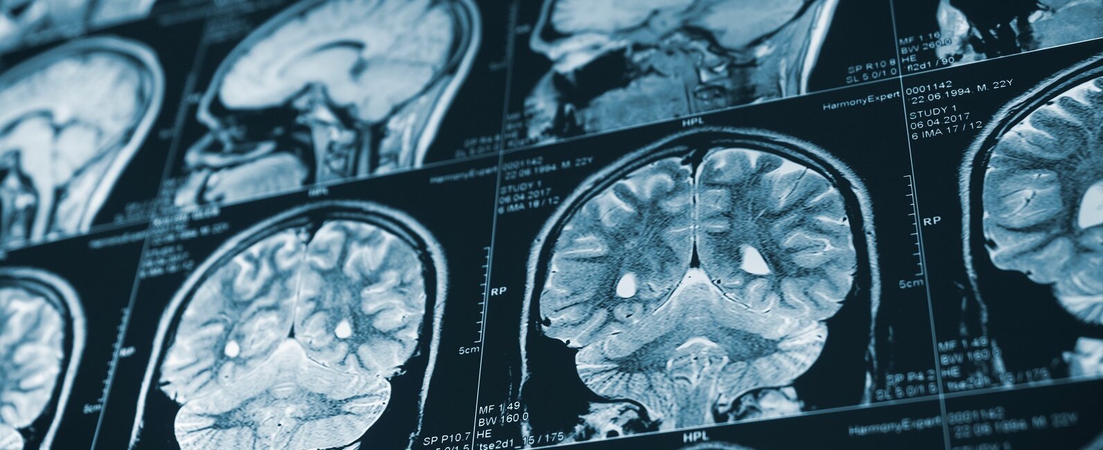 Stroke - ha ismered a tüneteit, életet menthetsz!